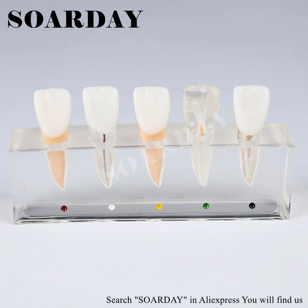 Endodontic Restoration Model (5)