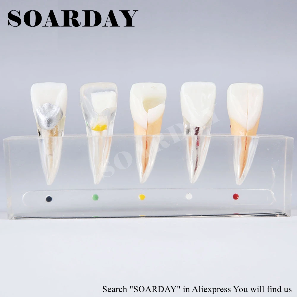 Endodontic Restoration Model (3)