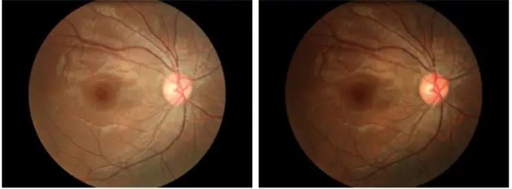 Non-mydriatic Automated Fundus Camera With Fluorescein Angiography