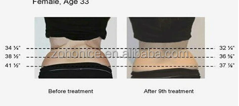 best rf radio frequency ultrasonic cavitation slimming machine