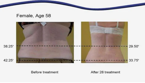 cavitation RF slimming machine/cavitation machine/ultrasonic cavitation rf slimming