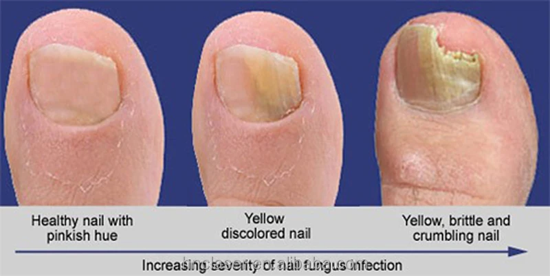 Pseudomonas Health Nails Laser Therapy Of Onychomycosis Is Safe And Very Efficient Method For Treating All Types Ca By Various Fungal Species