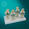 Plastic 4 Stages Knee Joints Synthesis Model skeleton 4-Stage Osteoarthritis Knee for teaching