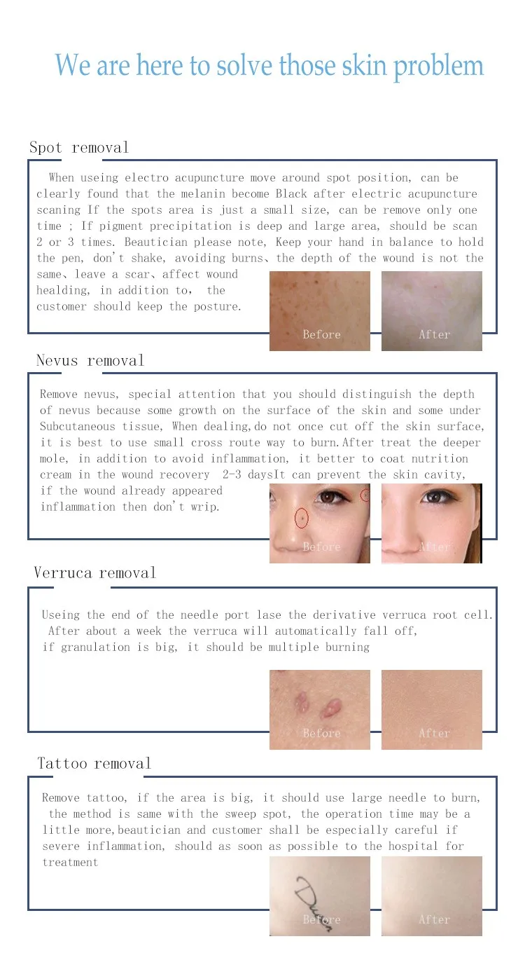 2016 Latest High-tech skin tag wart spot removal beauty pen for skin care