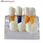 High Quality Resin 4 Times Dental tooth implant model