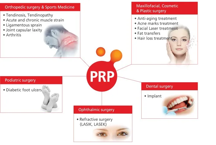 Prp 의료 하 혈소판이 풍부한 혈장 키트 10 미리리터 prp 튜브 무릎 ...