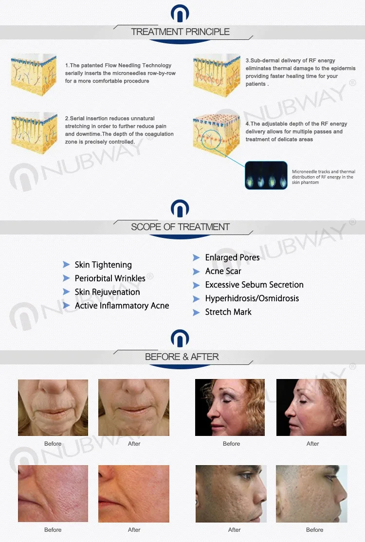 Portable equipment Fractional RF microneedle / micro needle skin tightening machine / acne scar removal rf needle machine