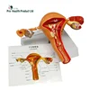 Normal & Pathological 3D plastic Ovary Uterus Anatomical Model