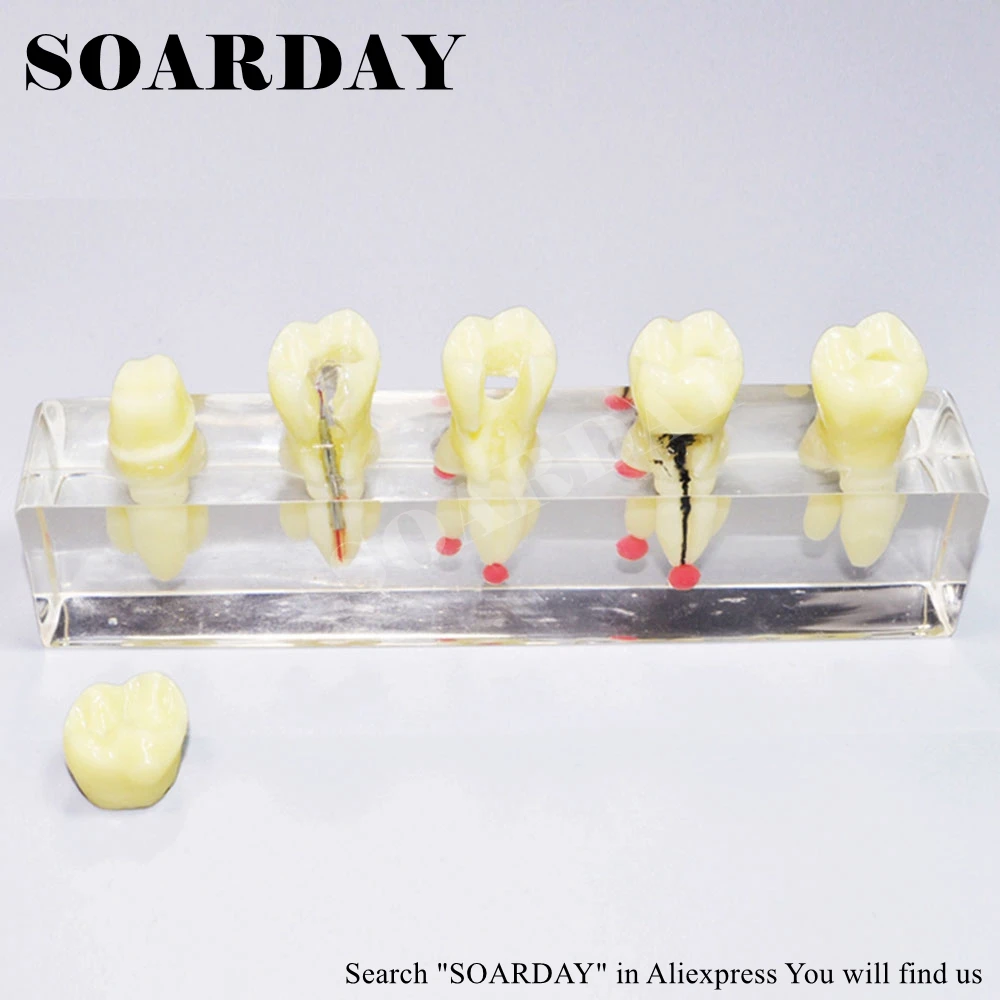 Tooth Root Canal Restoration Model (3)