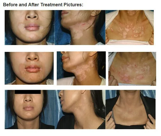 Medical equipment Psoriasis, vitiligo and eczema treatment UVB phototherapy KN-4003BL2D