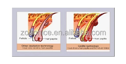 Hot use in italy salons permanent Hair Removal beauty machine