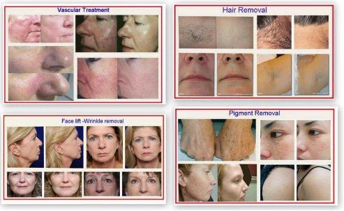 IPL hair removal machine before and after