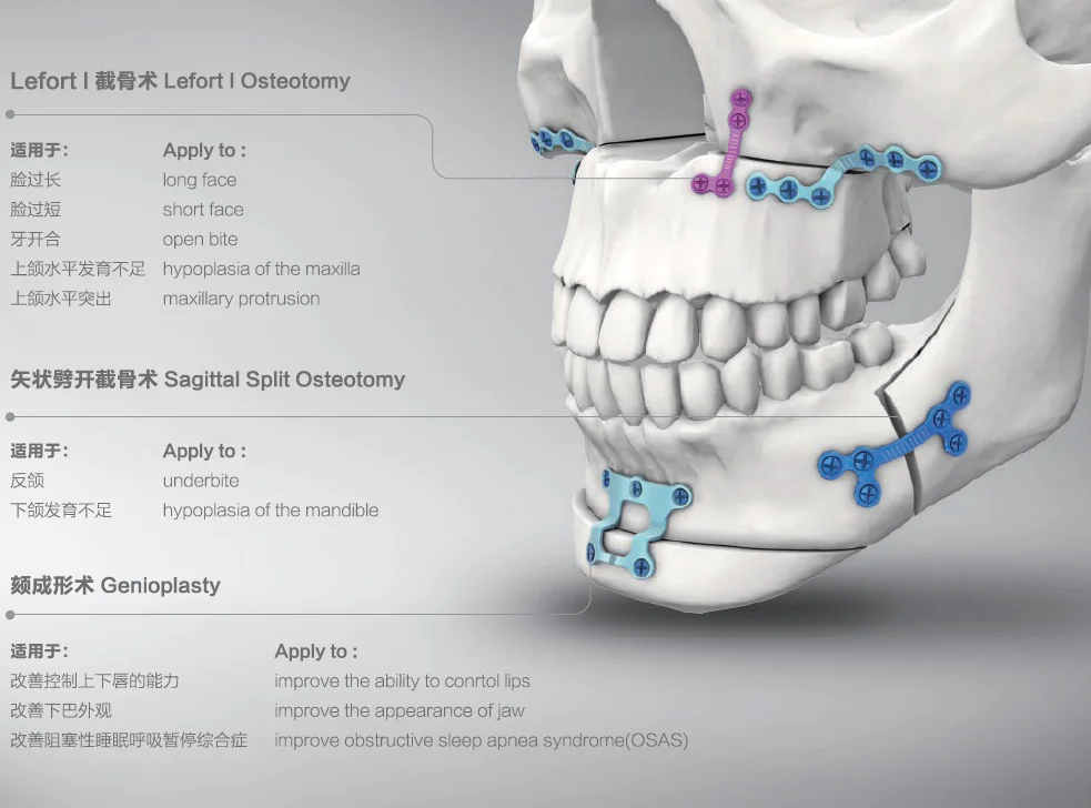 颌面正颌钛微板手术骨折螺钉和板
