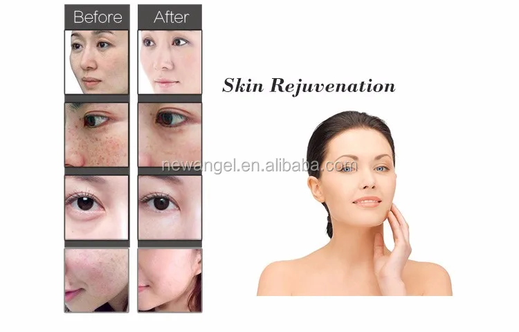 IPL-before-and-after_02.jpg