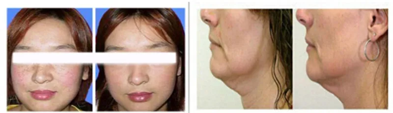 rf machine,radio frequency skin care face lifting,wrinkle removal machine