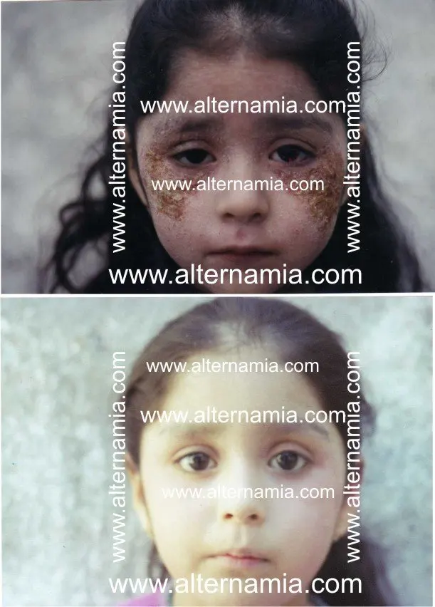 Eczema di medicina di malattia della pelle
