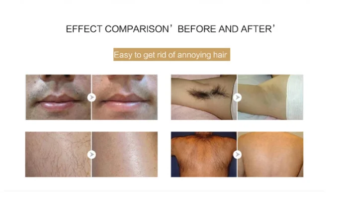 permanent facial hair removal cost