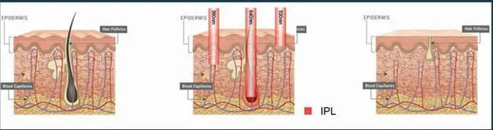 2015 CE approved high energy ipl phoofacial machine