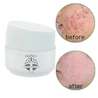 OEM ODM skin care oil control acne removal treatment cream whitening acne care cream