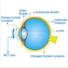 Digital Rigid contact lens for Myopia control / MCT/ Luxuriant metamorphosis of RGP Lenses