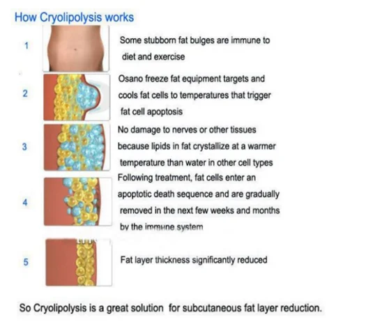 Cyrolipolisis fat freezing rf + cavitation body slimming machine