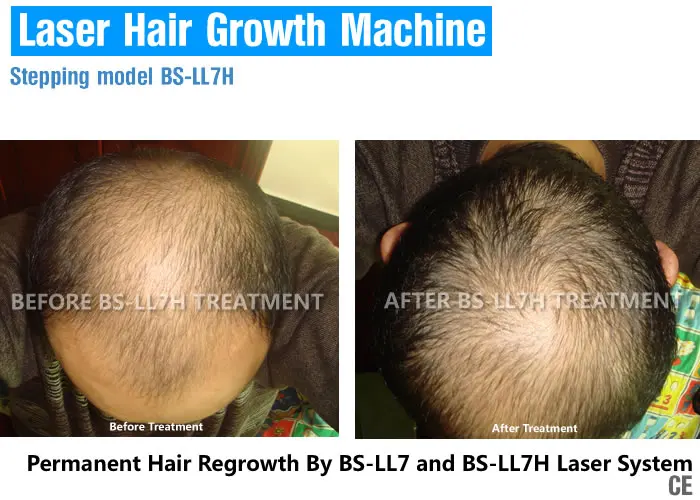 laser-hair-growth_1_3.jpg