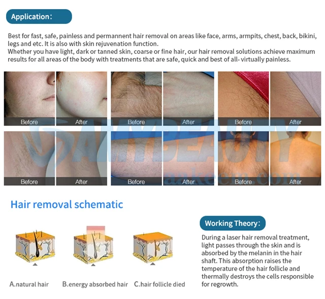 biggest spot size ipl hair removal machine.jpg