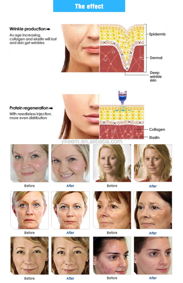 hyaluron pen injector.jpg