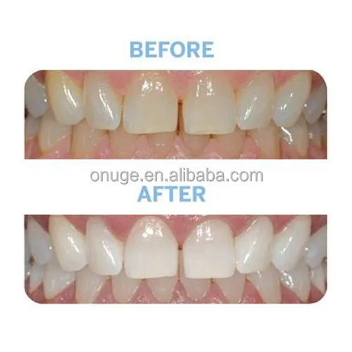 Do Whitening Strips Damage Your Teeth?