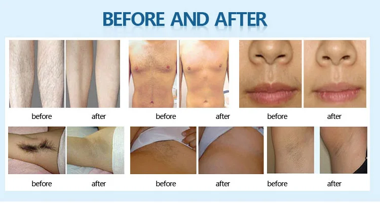Factory price newest professional alma soprano xl 808nm diode laser hair removal machine