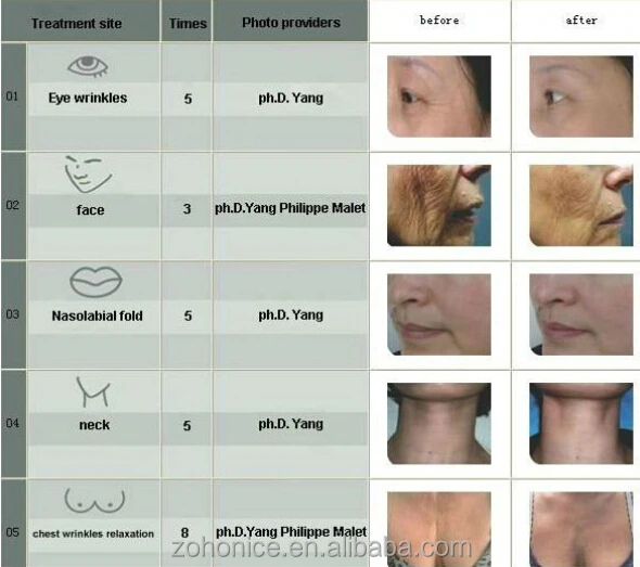 Top grade professional cavitation rf skin lifting machine