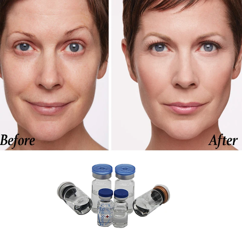Инъекции гиалуроновой кислоты для лица фото до и после