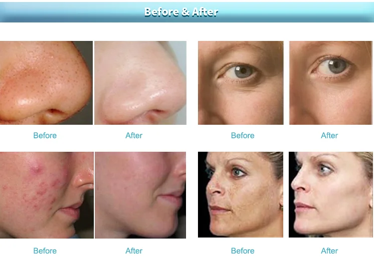 Smart Ice Blue 7 In 1 Skin Jet Peel Facial Ultrasonic Skin Rejuvenation With Skin Analysis Machine