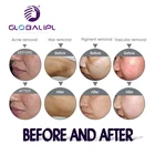 OPT SHR IPL machine for permanent hair removal skin rejuvenation Vascular Pigmentation