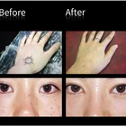 Effective Tattoo Removal Laser Pen Hot selling No Pain Pico Laser Tattoo Removal Price