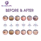 Laser Hair Removal Ipl Tattoo Medical CE Approved Beauty Equipment E-Light IPL Shr Opt /IPL Laser/SHR For Permanent