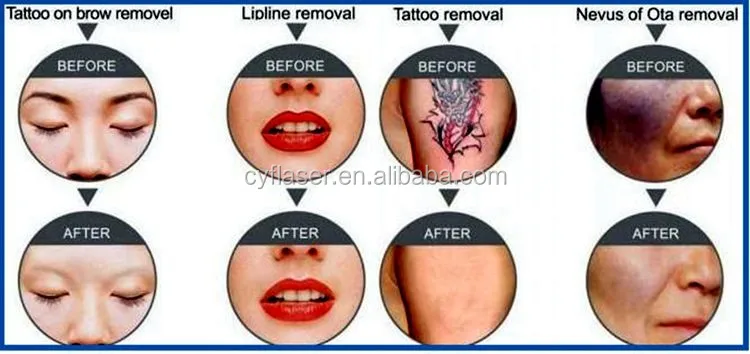 hair removal machine OPT SHR IPL +nd yag laser..-