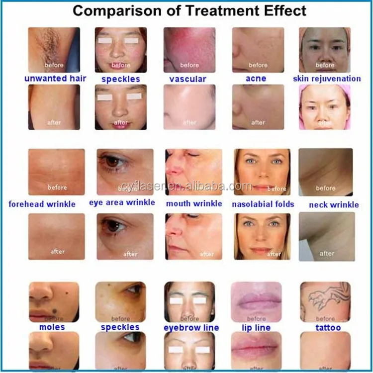 e-light-ipl-rf%2Bnd-yag-laser-4-in-1-multifunction-beauty-machine-1_%E5%89%AF%E6%9C%AC_.jpg