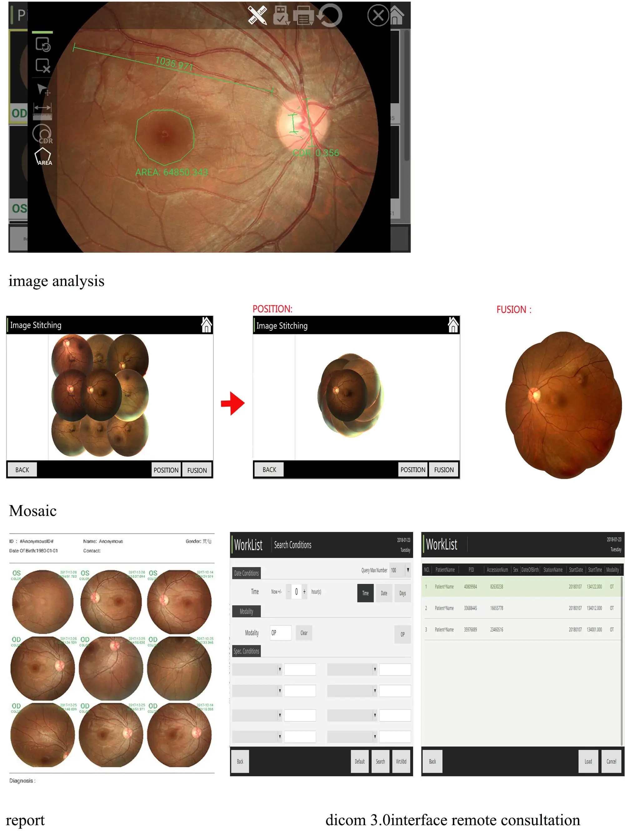 Non-mydriatic Automated Fundus Camera With Fluorescein Angiography