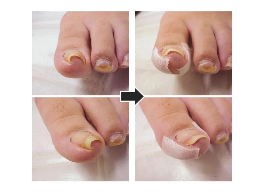 Dr. Kralle Toenail Corrector,Care At Home And Salon,Toenail Tool And