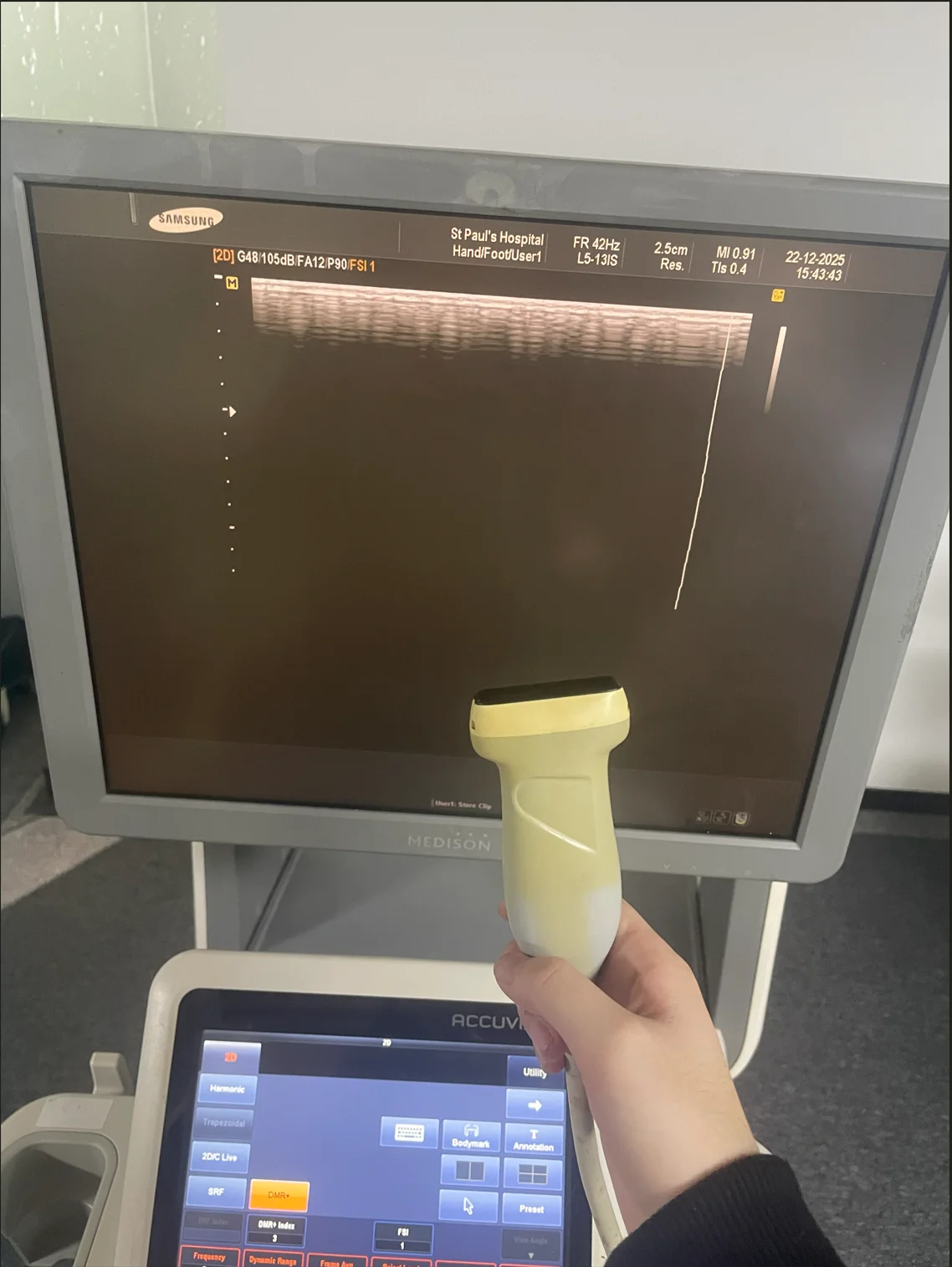 Samsung Accuvix XG Detail