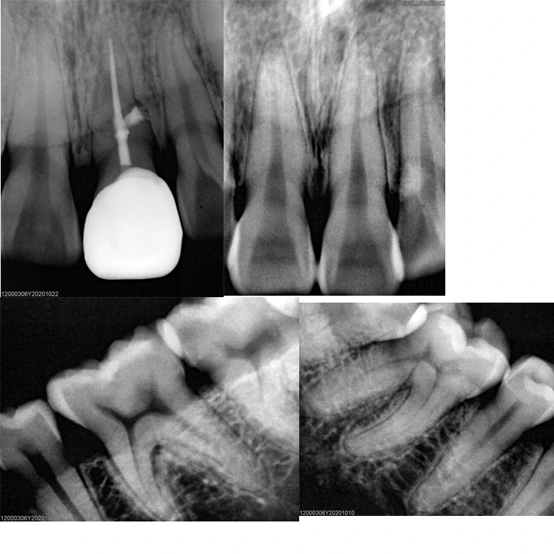 Ce Approved Digital Sensor Size 1.3 Imaging System Dental X Ray Sensor