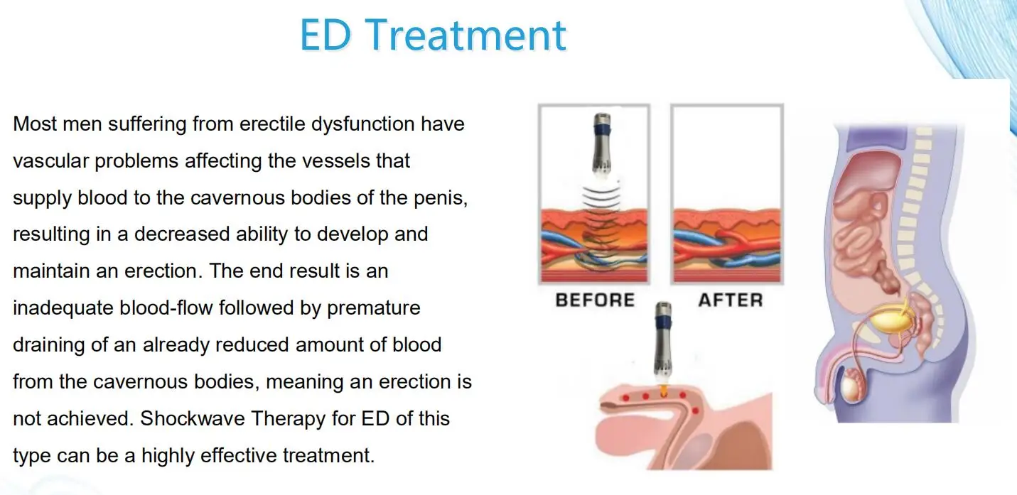 ED treatment ems shockwave therapy muscle stimulation.jpg.jpg