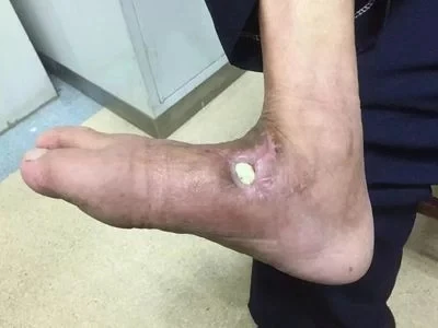 wound dressing 03.jpg