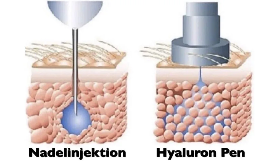 Skinject Hyaluronic Acid 0.5ml Ampoule For Mesotherapy Gun.jpg