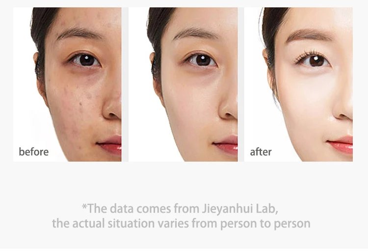 Treatment Acne Herbal Mint Cool Moisturizer Remove Acne Scars Anti Acne