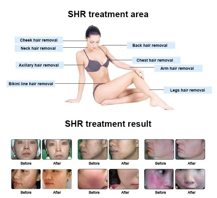 shr treatment area