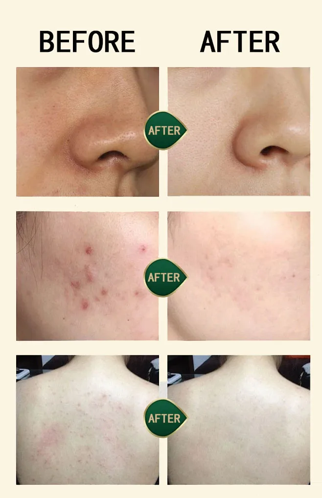 Cheap Original Natural Scented Vitamin C Sulfur Face Skin Whitening