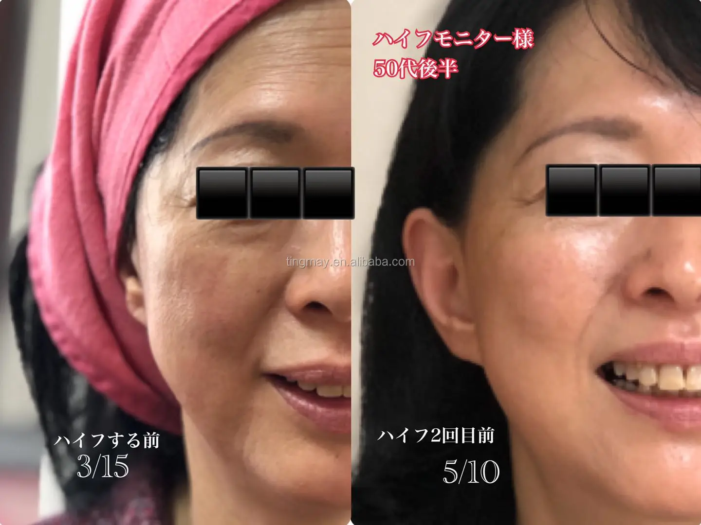 2019 Nuevo Vmax Hifu Ultrasonido Hifu 3 0mm 4 5mm Lifting Facial Y