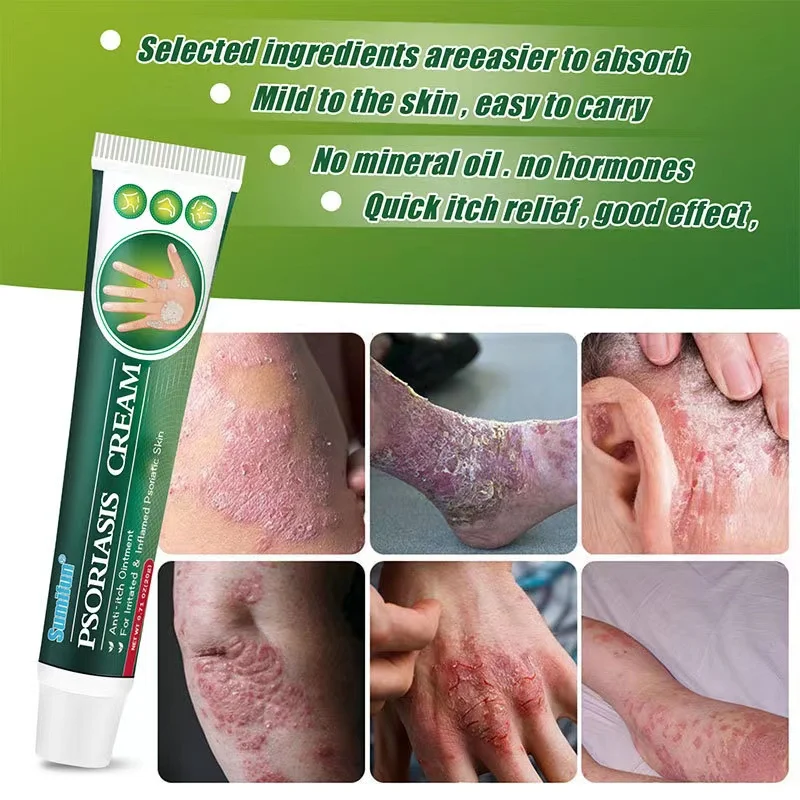 Hot Selling Fungal Infection Skin Psoriasis Creams Dermatitis Eczema Ointment Treatment
